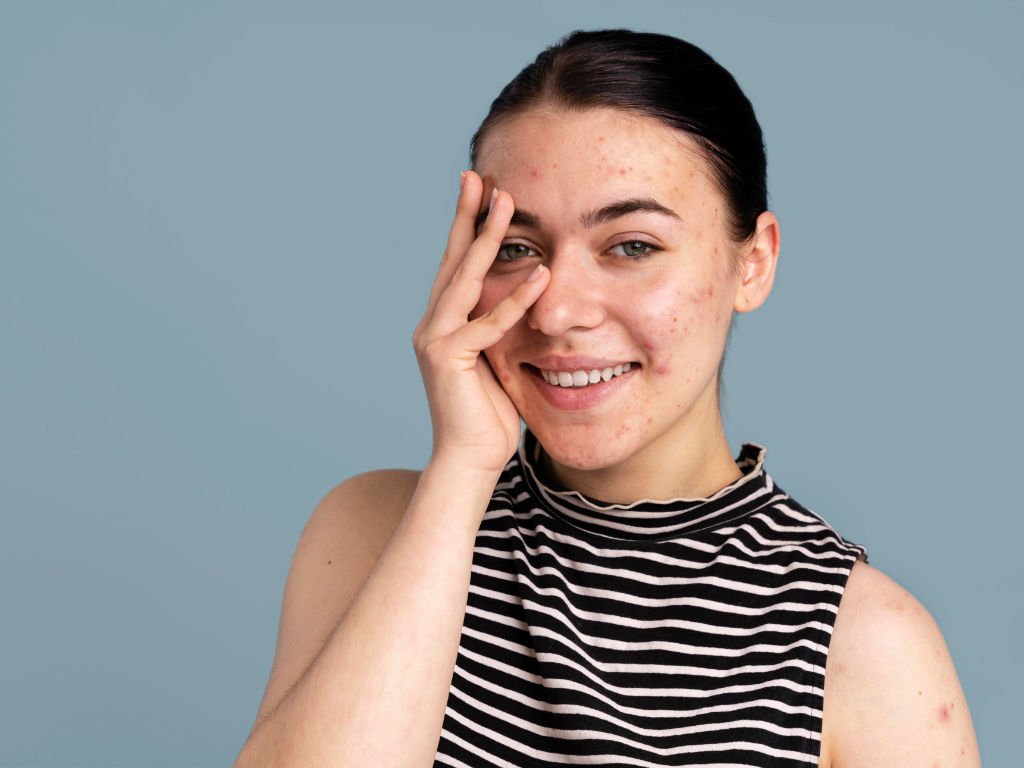 Woman with acne-prone skin showing skin conditions that benefit from turmeric skin benefits and natural treatment